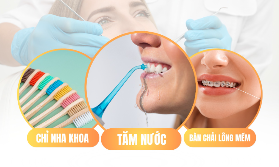 DỤNG CỤ VỆ SINH RĂNG KHÔNG THỂ THIẾU VỚI ĐỒNG NIỀNG VÀ IMPLANT