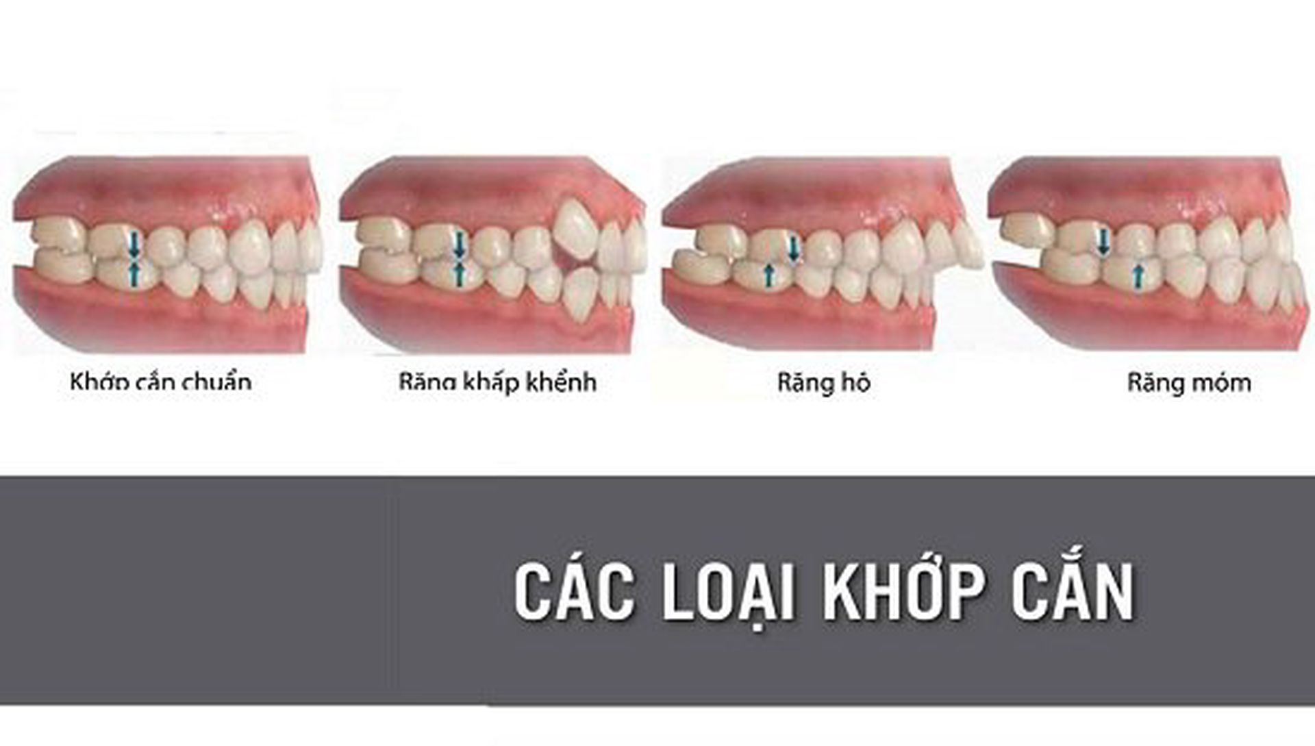 Tác hại và cách điều trị răng lệch khớp cắn