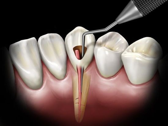 Điều cần biết và cách chăm sóc răng miệng sau khi điều trị Nội Nha 