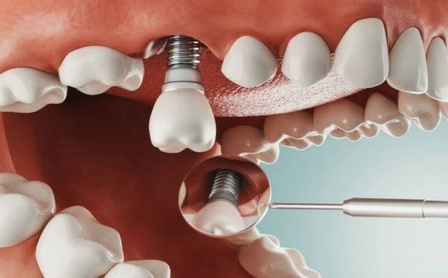 Khóa Học Implant Cơ bản A-Z