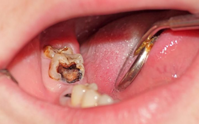 CÓ NÊN NHỔ RĂNG HÀM KHI BỊ SÂU?