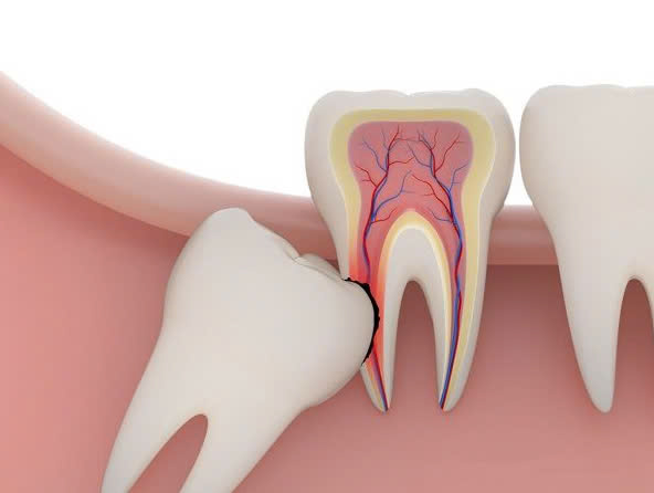 NHỮNG TÁC HẠI KHÓ LƯỜNG CỦA RĂNG KHÔN MỌC LỆCH - VIDES