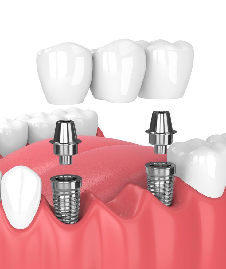 CÓ NÊN CẤY GHÉP RĂNG IMPLANT ĐỂ PHÒNG NGỪA TIÊU XƯƠNG Ổ RĂNG KHÔNG?