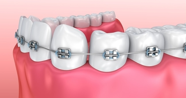 Hậu Quả Của Việc Niềng Răng Kém Chất Lượng