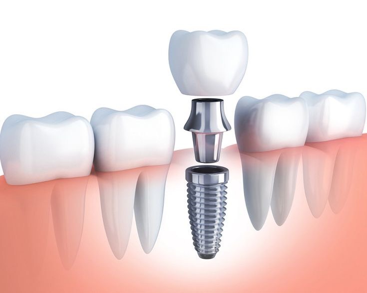 Cấy ghép Implant là gì? Những điều cần biết trước khi thực hiện 