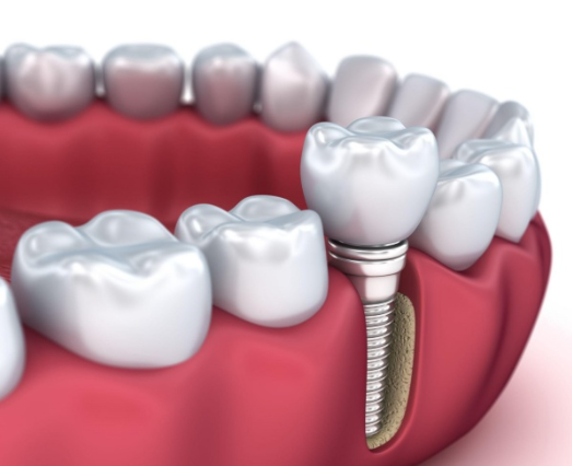 TRỒNG RĂNG IMPLANT