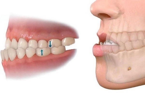 LỆCH KHỚP CẮN – RĂNG HÔ, MÓM, CHEN CHÚC: TOÀN DIỆN VỀ MỘT VẤN ĐỀ NHA KHOA PHỔ BIẾN