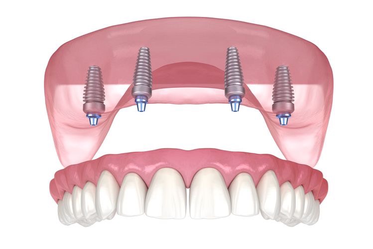 Những điều cần biết về cấy ghép implant trong nha khoa