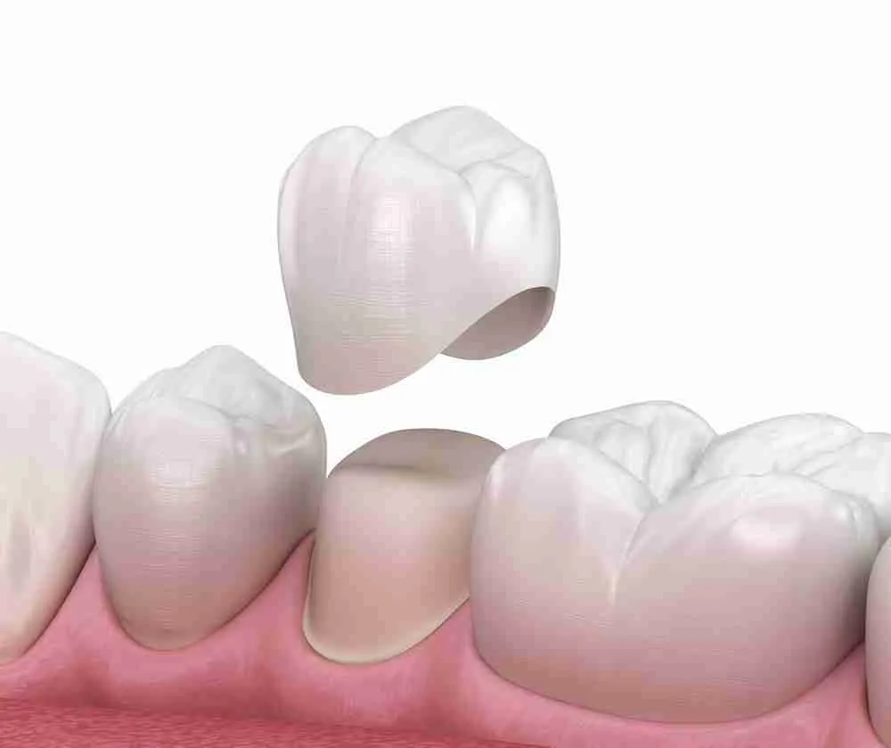 Trồng Răng Sứ: Giải Pháp Phục Hồi Răng Mất Thẩm Mỹ Và Hiệu Quả
