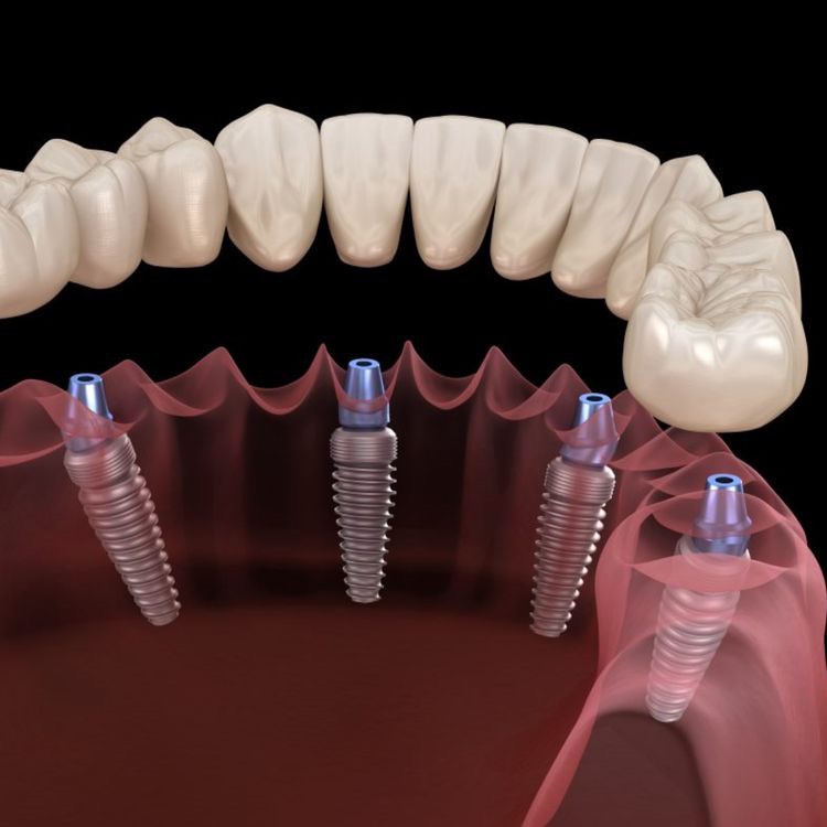 Trồng răng implant toàn hàm có ưu điểm gì?