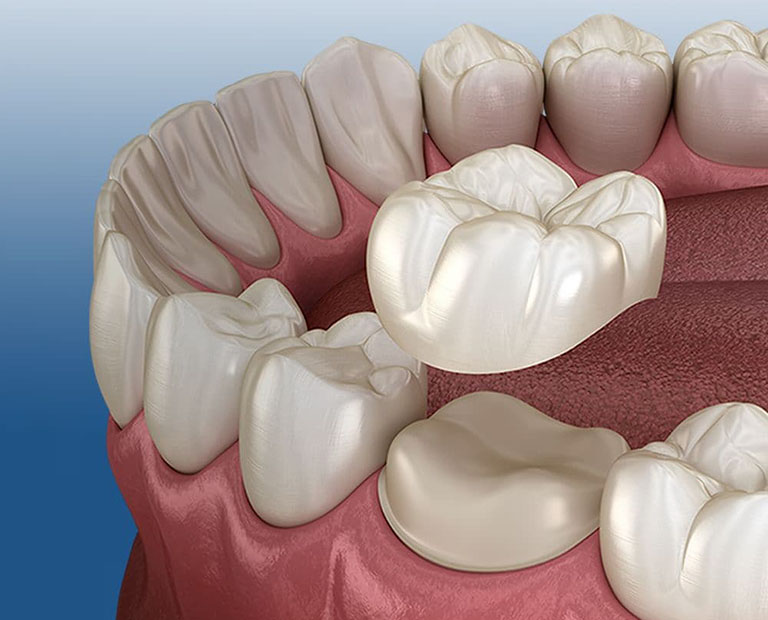 PHỤC HÌNH RĂNG - GIẢI PHÁP HOÀN HẢO CHO NỤ CƯỜI HOÀN MỸ