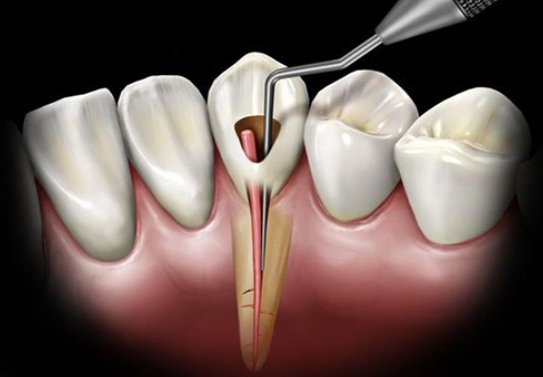 Nội Nha: Điều Trị Tủy Răng Là Gì Và Khi Nào Cần Thực Hiện?