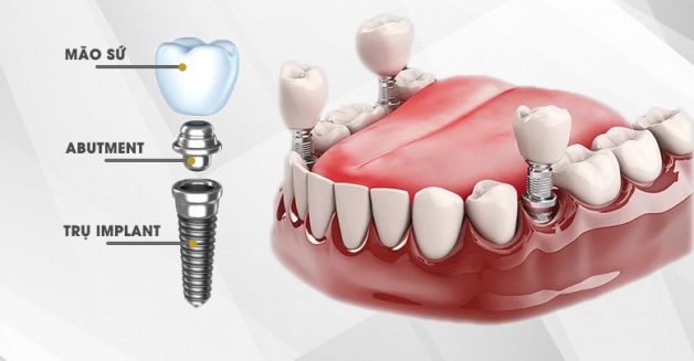 Khóa học Implant cơ bản AZ