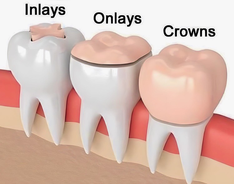 Thông tin cơ bản về trám răng và mão răng 