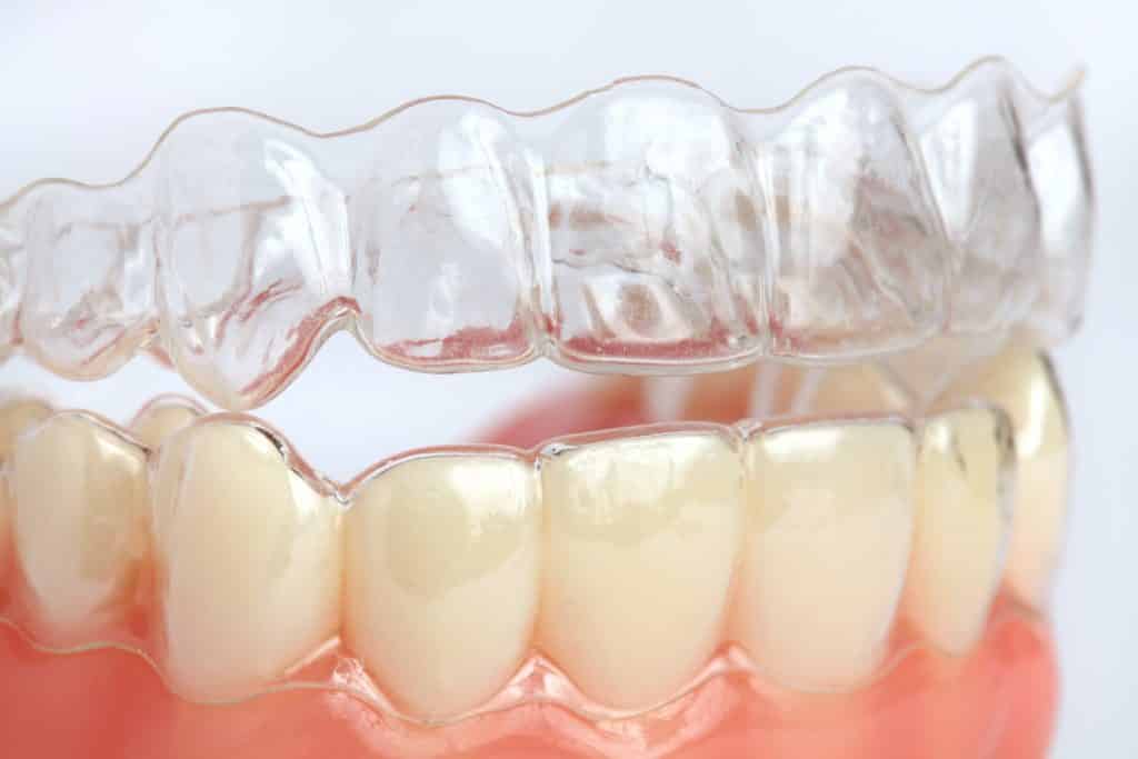 Chỉnh nha máng trong suốt In - House