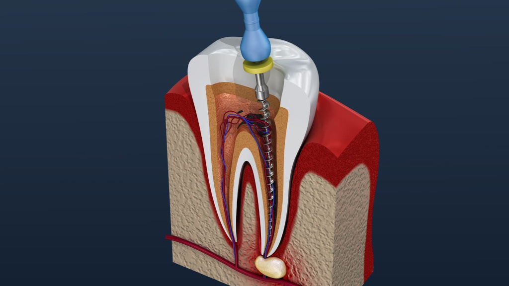 Nội nha (Điều trị tủy răng)